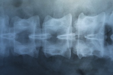 Photo of X-ray image of spinal column as background, closeup