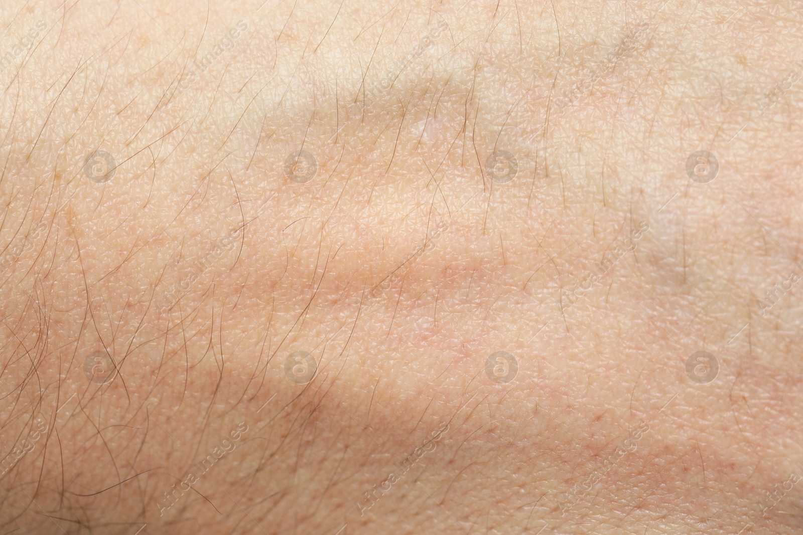 Photo of Texture of normal skin as background, closeup