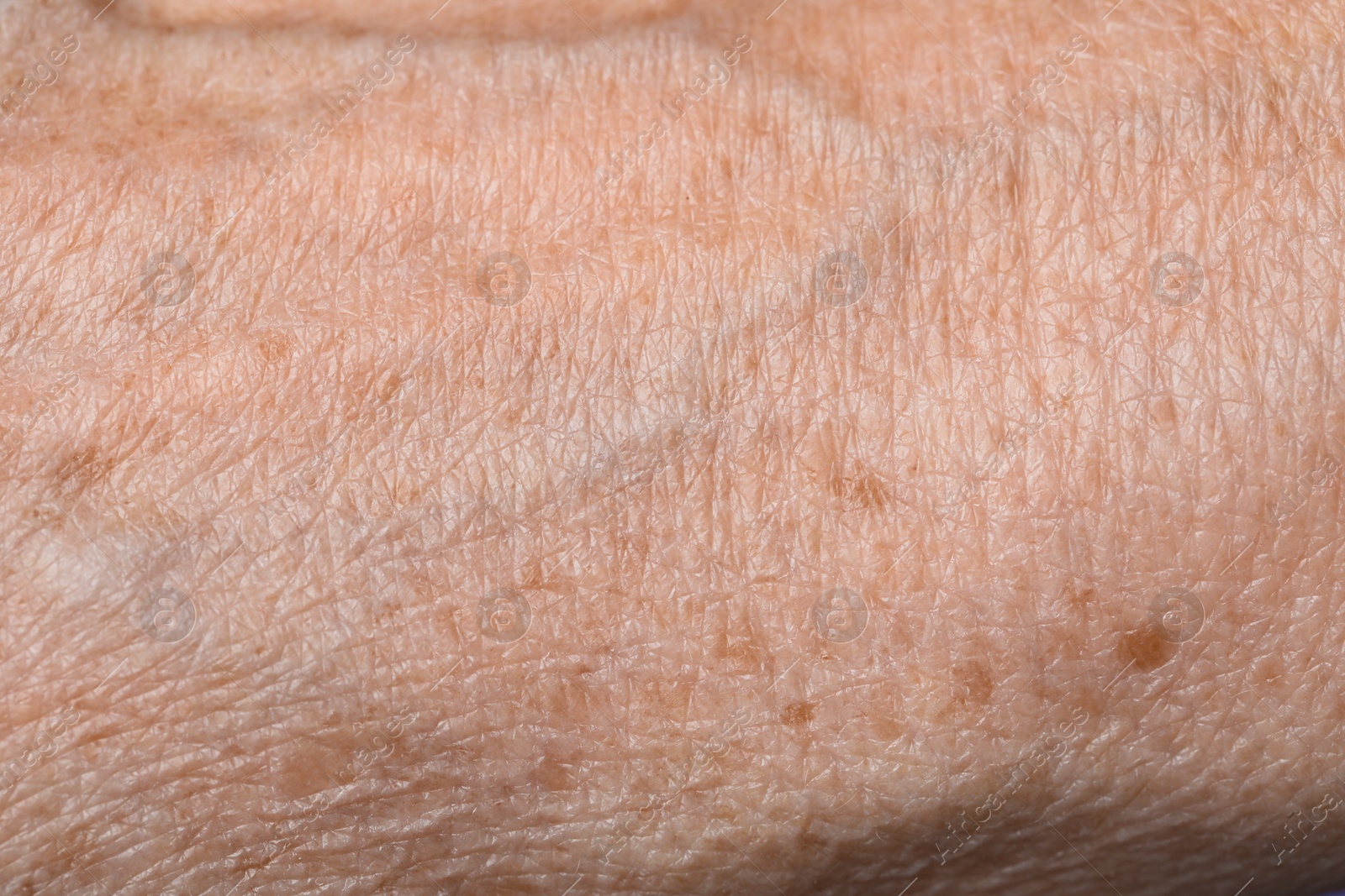 Photo of Macro view of skin with birthmarks as background