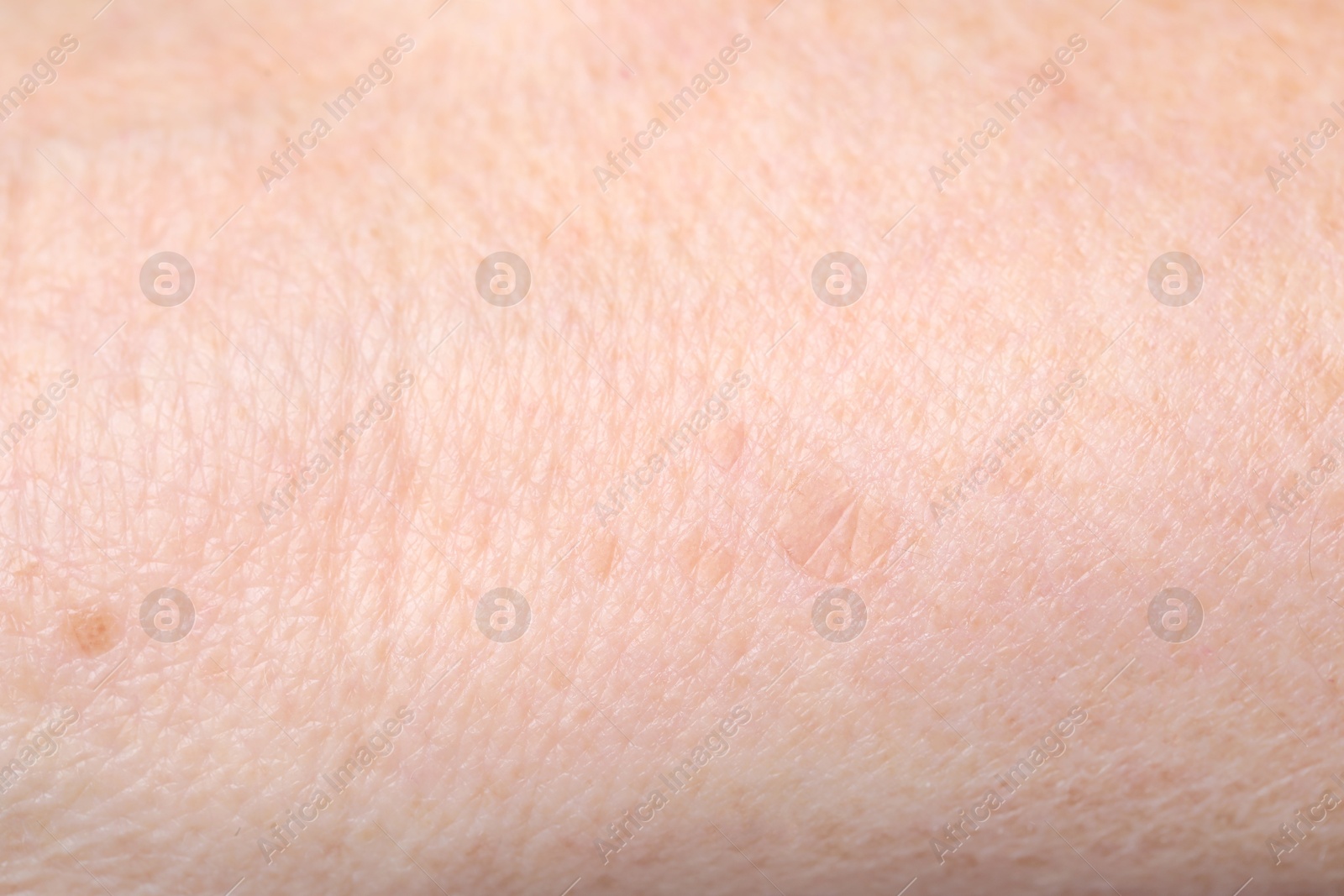 Photo of Macro view of skin with birthmarks as background