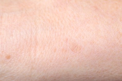 Macro view of skin with birthmarks as background