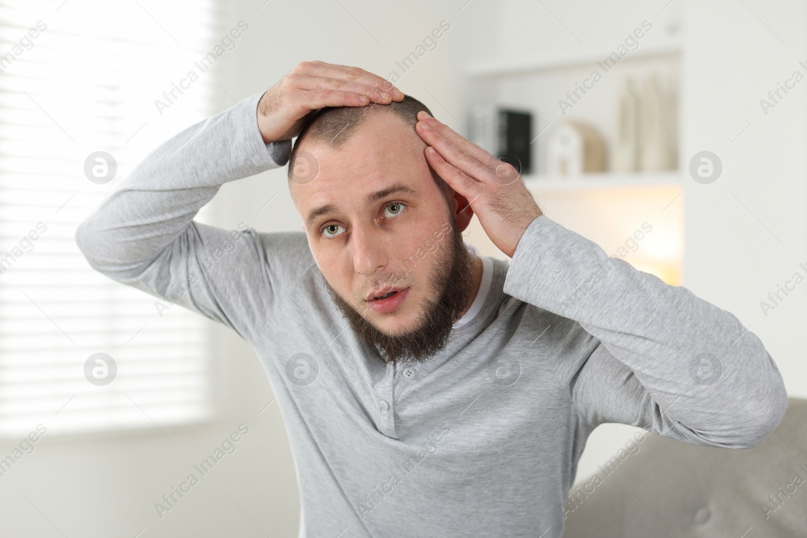 Baldness problem. Worried man with receding hairline at home Photo of Baldness problem. Worried man with receding hairline at home