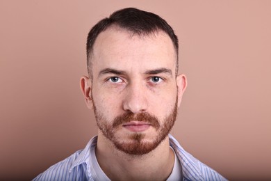 Photo of Baldness problem. Man with receding hairline on dark beige background