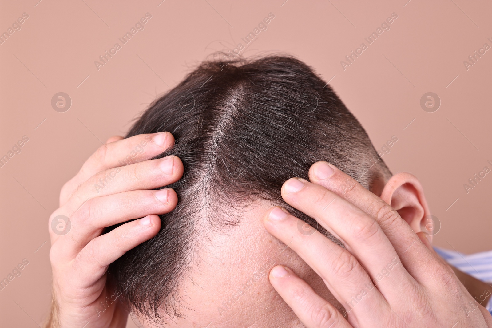 Photo of Baldness problem. Man with receding hairline on dark beige background, closeup