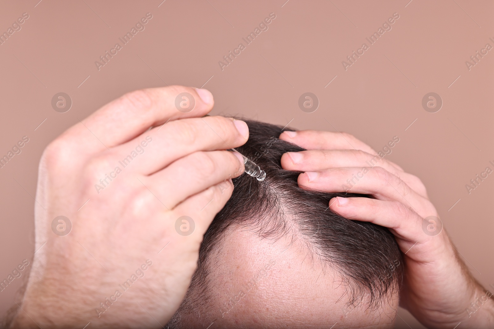 Photo of Baldness problem. Man applying serum onto hairline on dark beige background, closeup