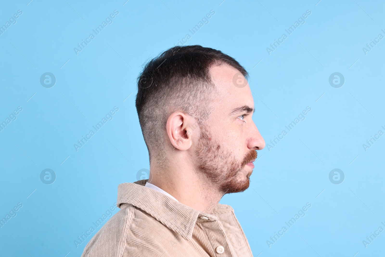 Photo of Baldness problem. Man with receding hairline on light blue background