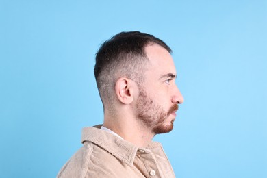 Baldness problem. Man with receding hairline on light blue background