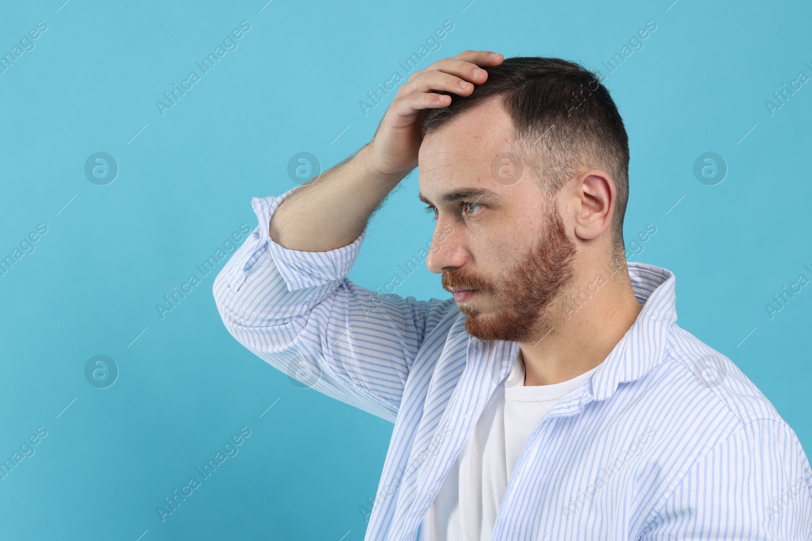 Photo of Baldness problem. Man with receding hairline on light blue background, space for text