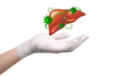 Doctor holding illustration of unhealthy liver on white background, closeup. Hepatitis