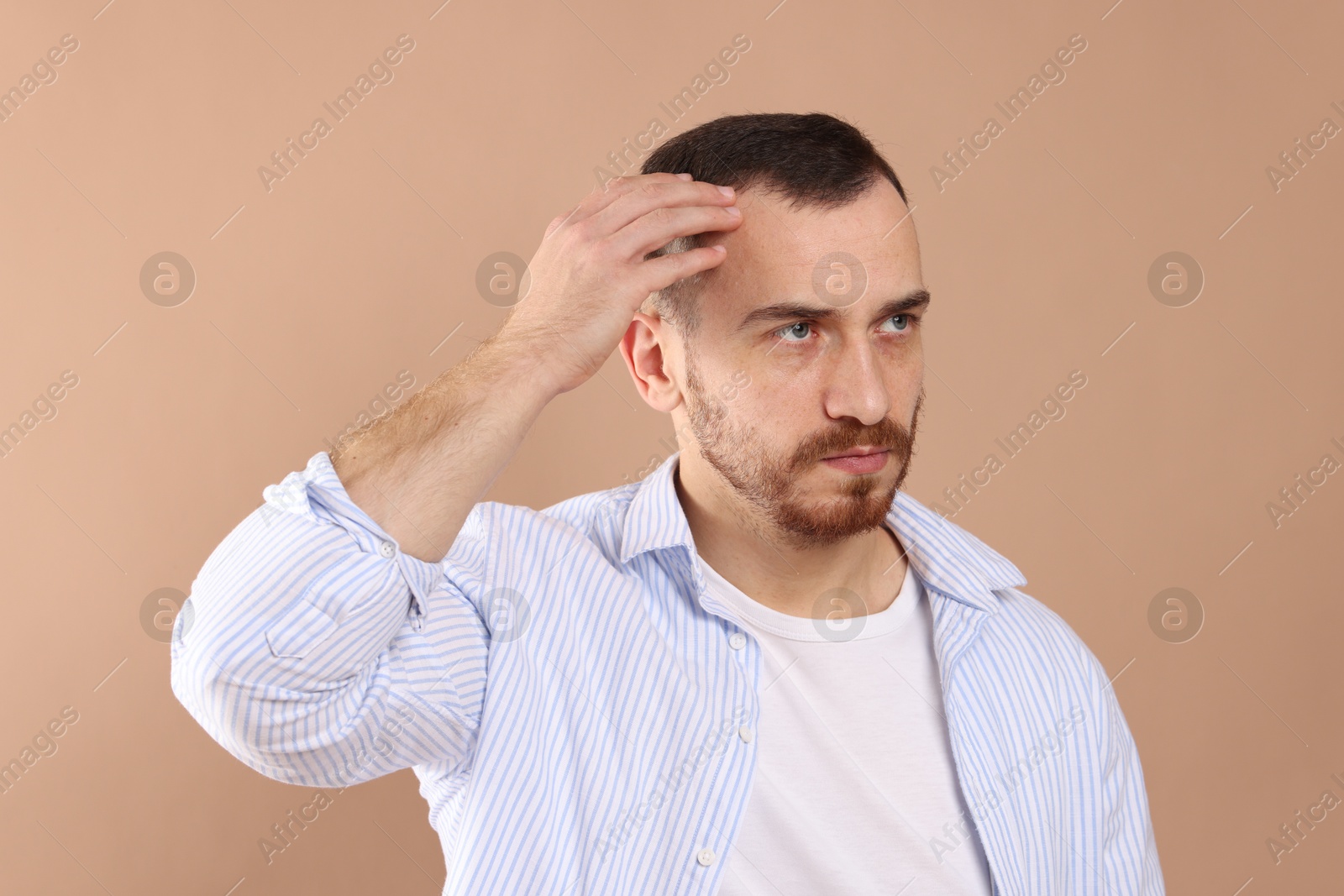 Photo of Baldness problem. Man with receding hairline on beige background