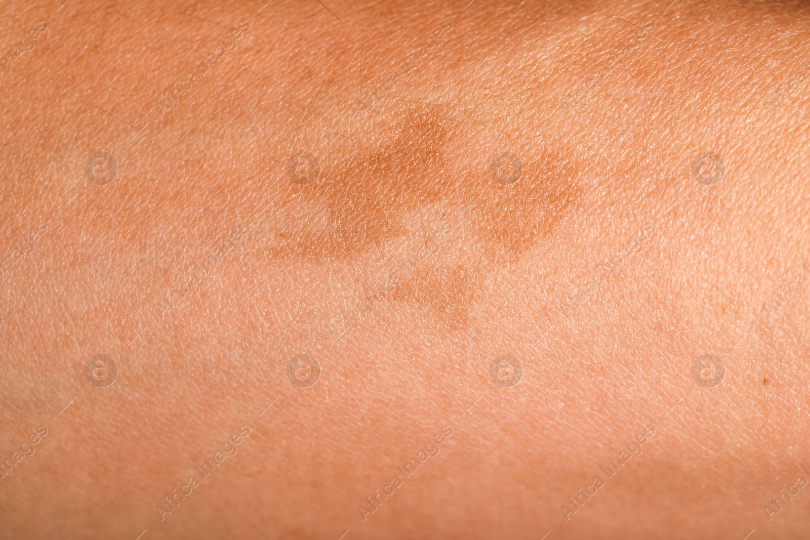 Photo of Texture of skin with birthmark as background, closeup