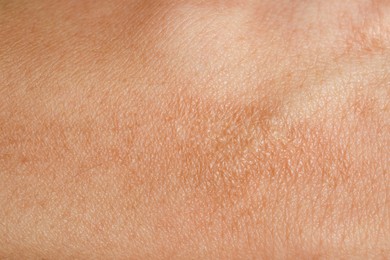 Photo of Texture of skin with scar as background, closeup