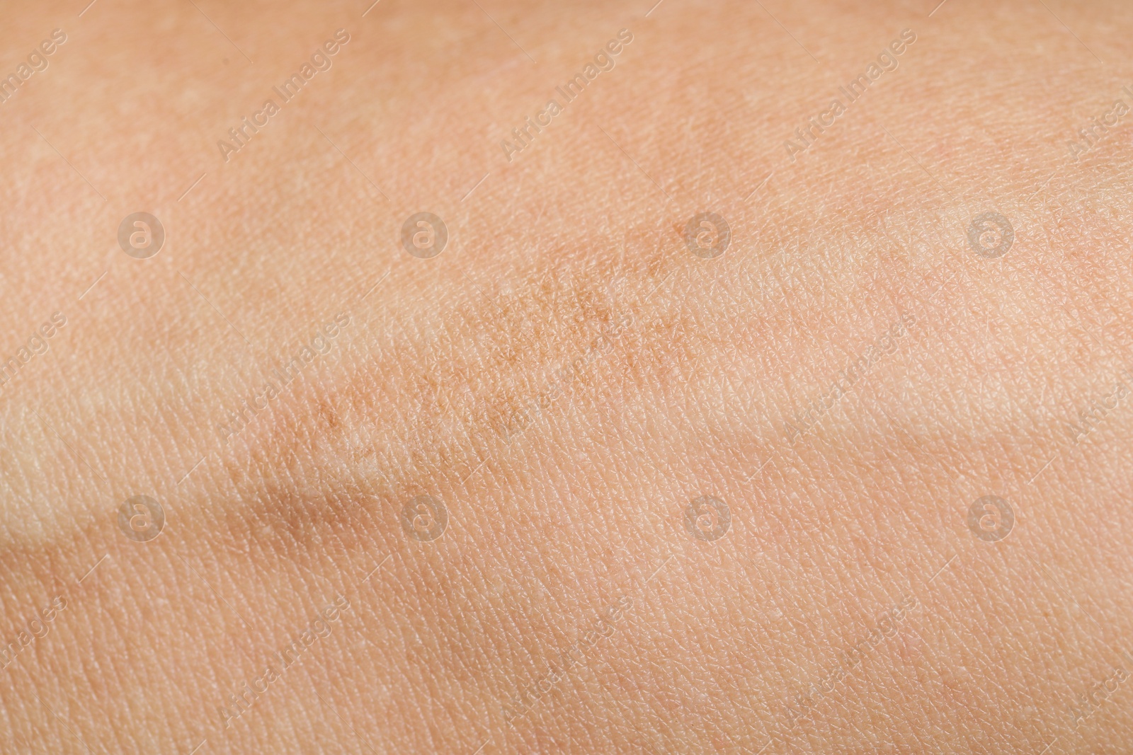 Photo of Texture of skin with scar as background, closeup