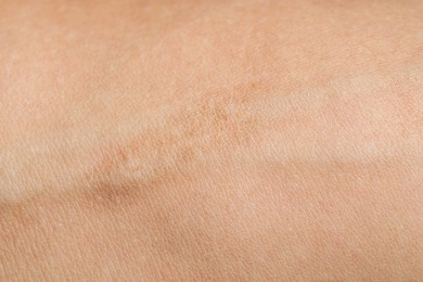 Photo of Texture of skin with scar as background, closeup