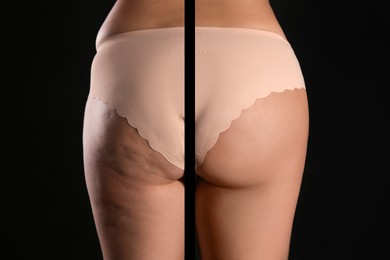 Image of Cellulite treatment, before and after collage. Young woman showing her buttocks and thighs on black background, closeup