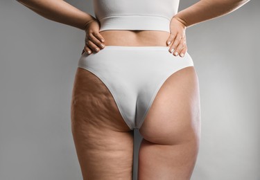 Image of Cellulite treatment, before and after collage. Young woman showing her buttocks and thighs on grey background, closeup