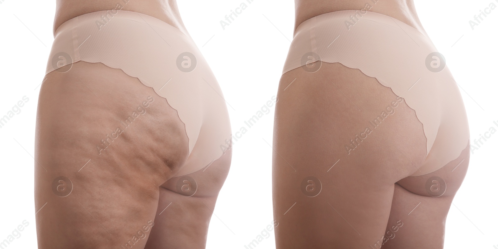 Image of Cellulite treatment, before and after collage. Young woman showing her body on white background, closeup