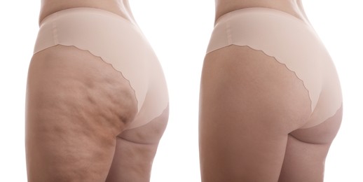 Cellulite treatment, before and after collage. Young woman showing her body on white background, closeup