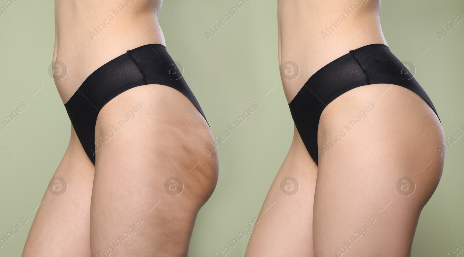 Image of Cellulite treatment, before and after collage. Young woman showing her body on color background, closeup