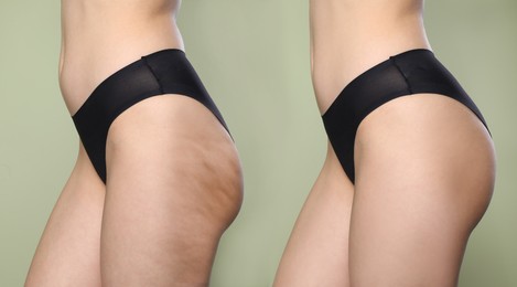 Cellulite treatment, before and after collage. Young woman showing her body on color background, closeup