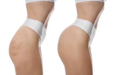 Image of Cellulite treatment, before and after collage. Young woman showing her body on white background, closeup