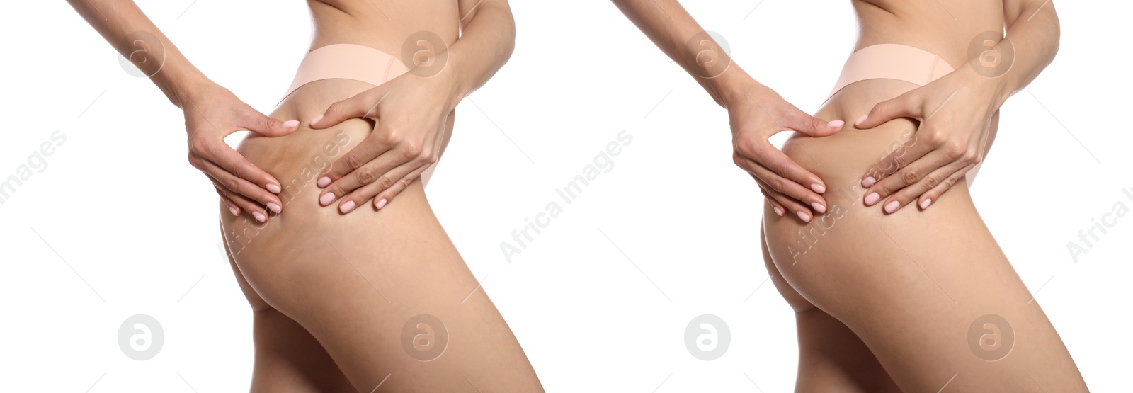 Image of Cellulite treatment, before and after collage. Young woman showing her body on white background, closeup