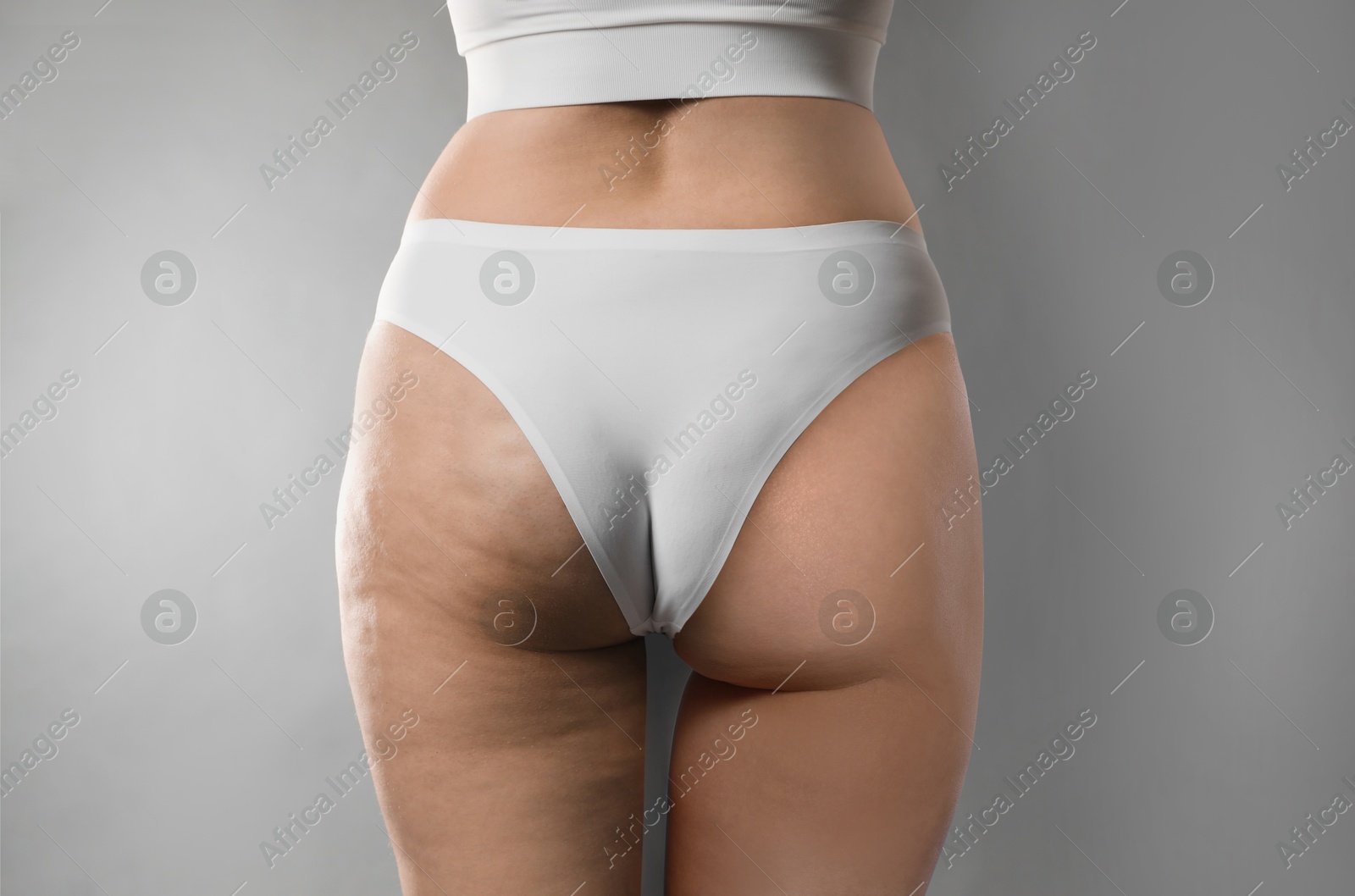 Image of Cellulite treatment, before and after collage. Young woman showing her buttocks and thighs on grey background, closeup