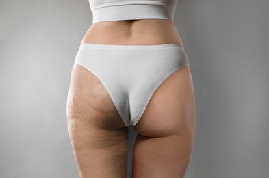 Cellulite treatment, before and after collage. Young woman showing her buttocks and thighs on grey background, closeup