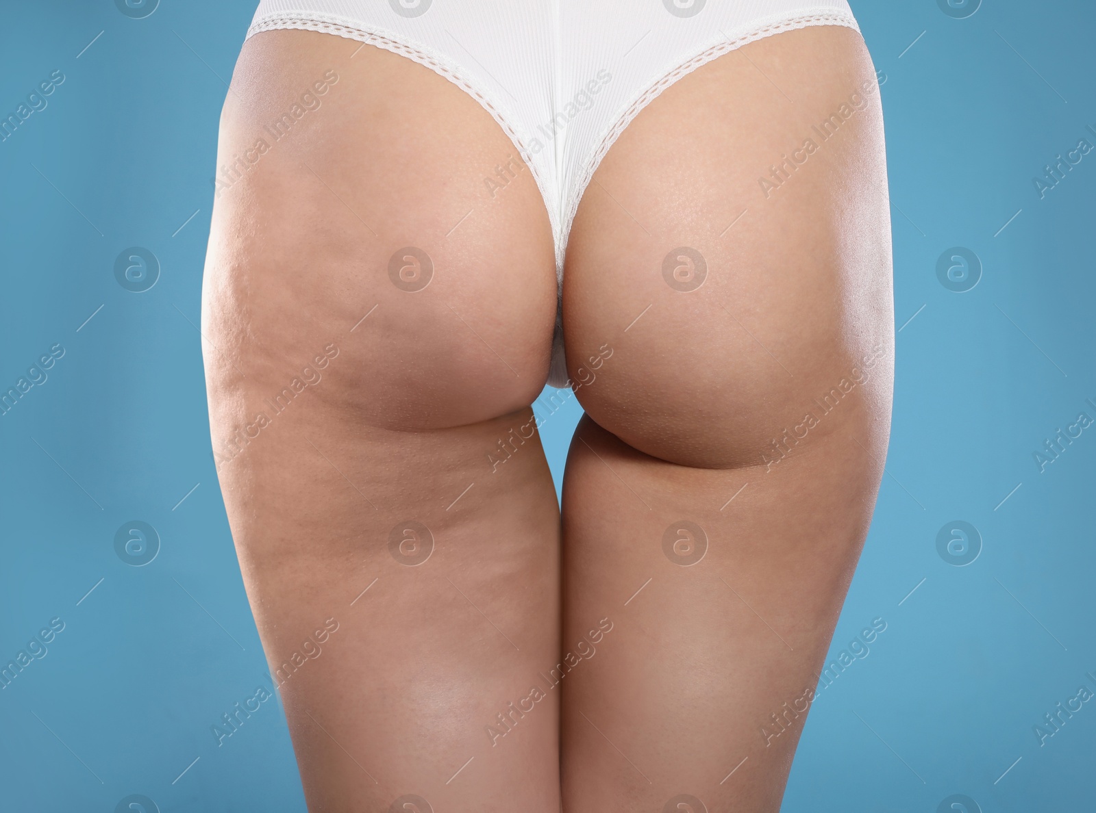 Image of Cellulite treatment, before and after collage. Young woman showing her buttocks and thighs on blue background, closeup