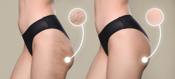 Image of Cellulite treatment, before and after collage. Young woman showing her body on dark beige background, closeup