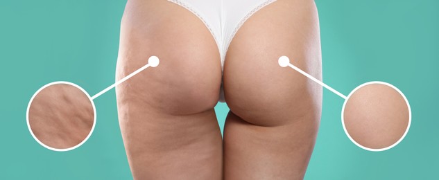 Image of Cellulite treatment, before and after collage. Young woman showing her buttocks and thighs on turquoise background, closeup