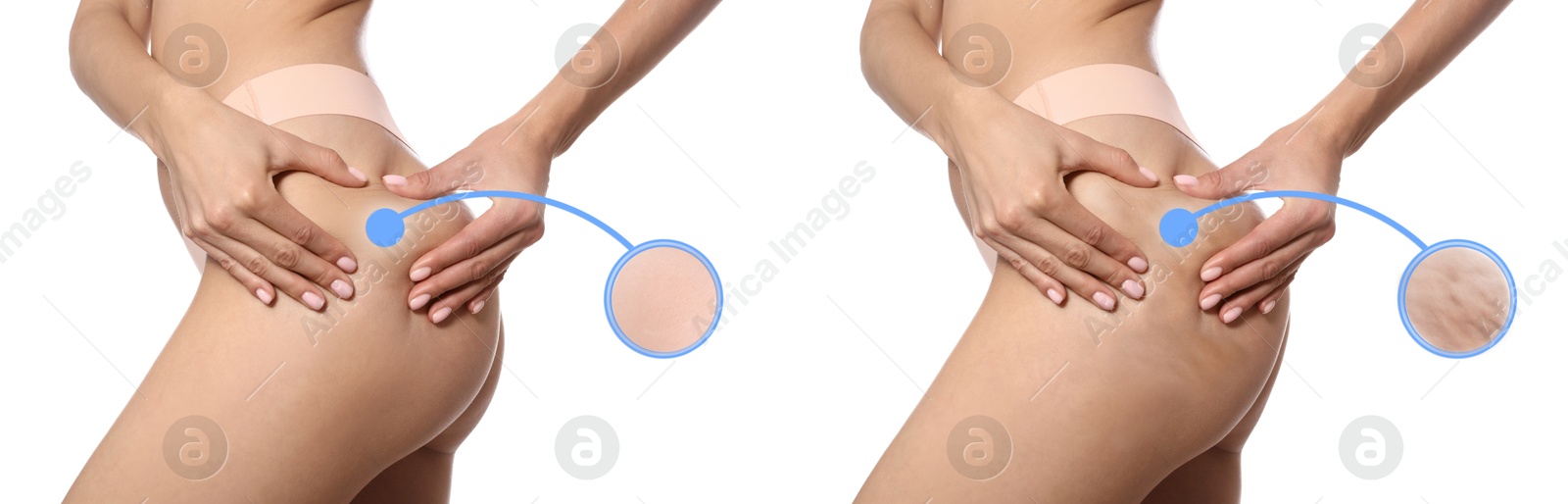 Image of Cellulite treatment, before and after collage. Young woman showing her body on white background, closeup