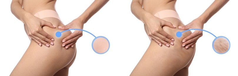 Cellulite treatment, before and after collage. Young woman showing her body on white background, closeup