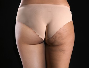 Image of Cellulite treatment, before and after collage. Young woman showing her buttocks and thighs on black background, closeup