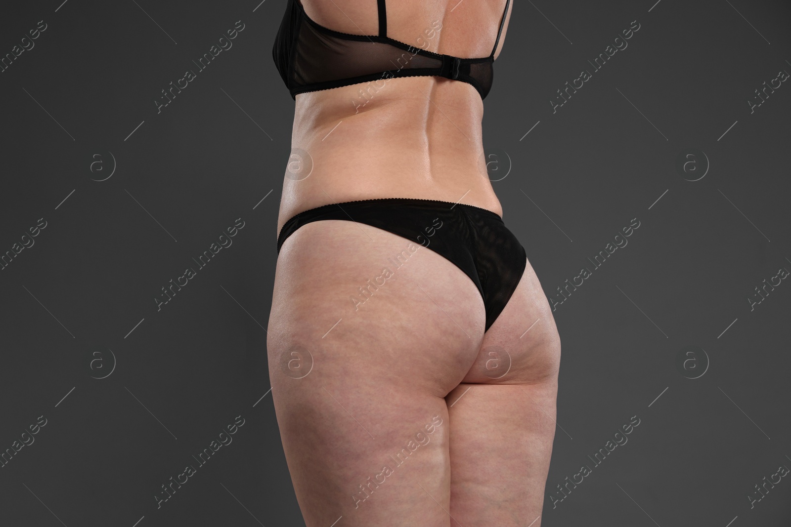 Photo of Woman with cellulite problem on dark grey background, closeup