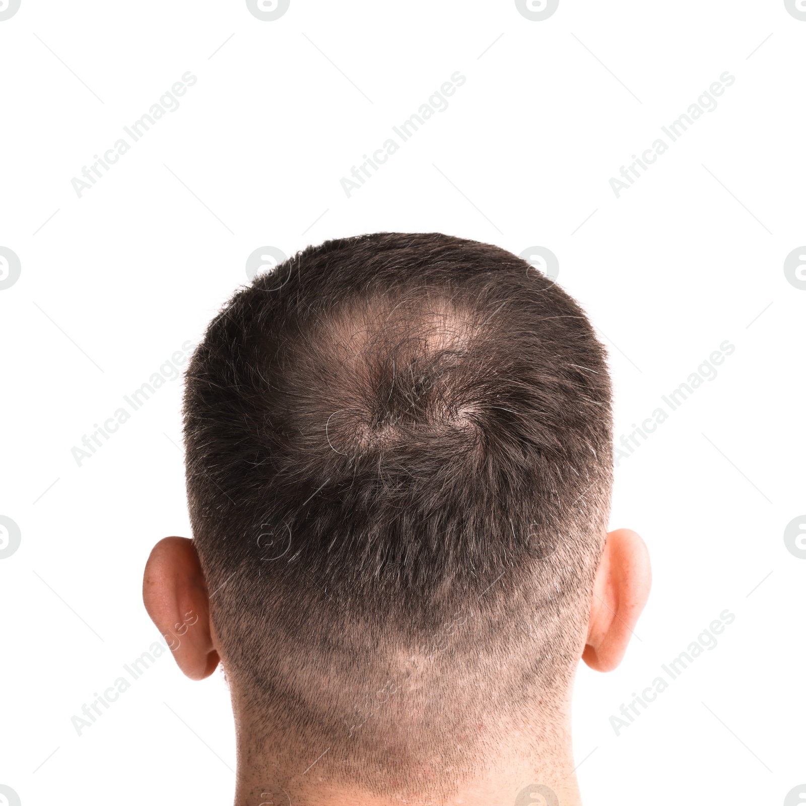 Photo of Man suffering from baldness on white background, back view