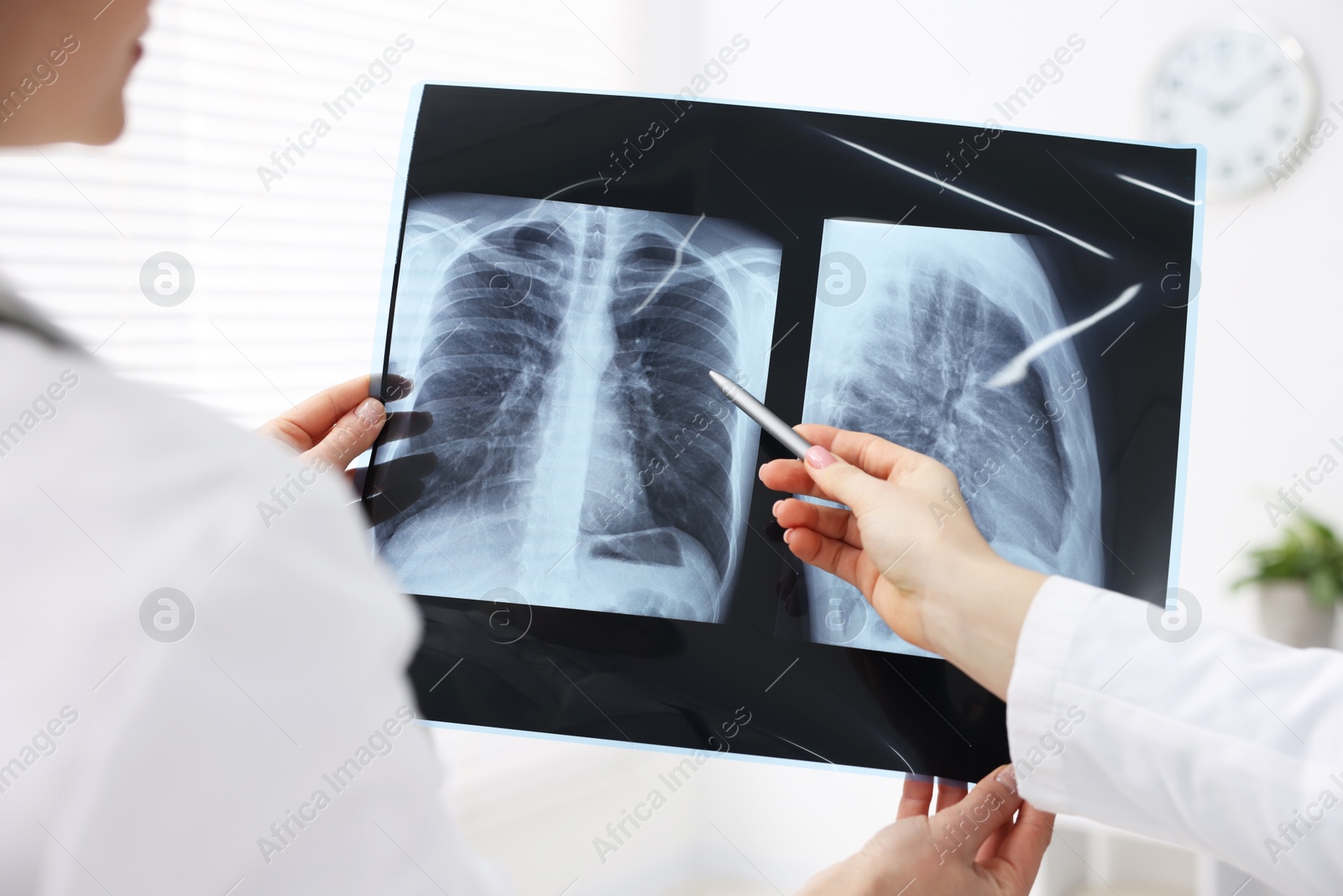 Photo of Doctors examining lungs x-ray in hospital, closeup