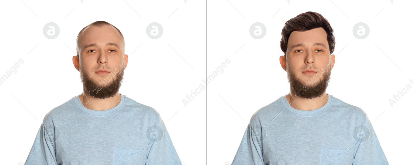 Baldness. Man before and after wearing wig or hair treatment on white background Image of Baldness. Man before and after wearing wig or hair treatment on white background