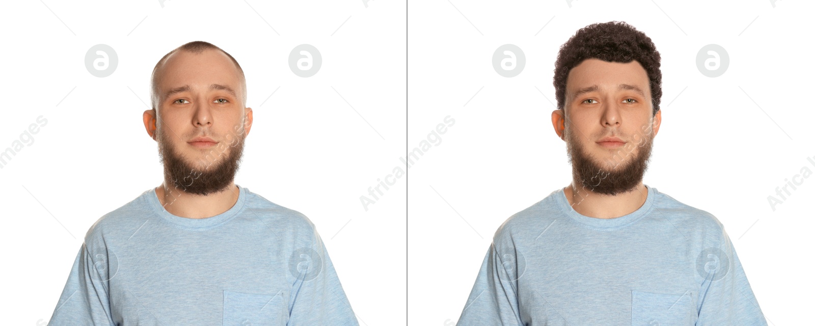 Baldness. Man before and after wearing wig or hair treatment on white background Image of Baldness. Man before and after wearing wig or hair treatment on white background