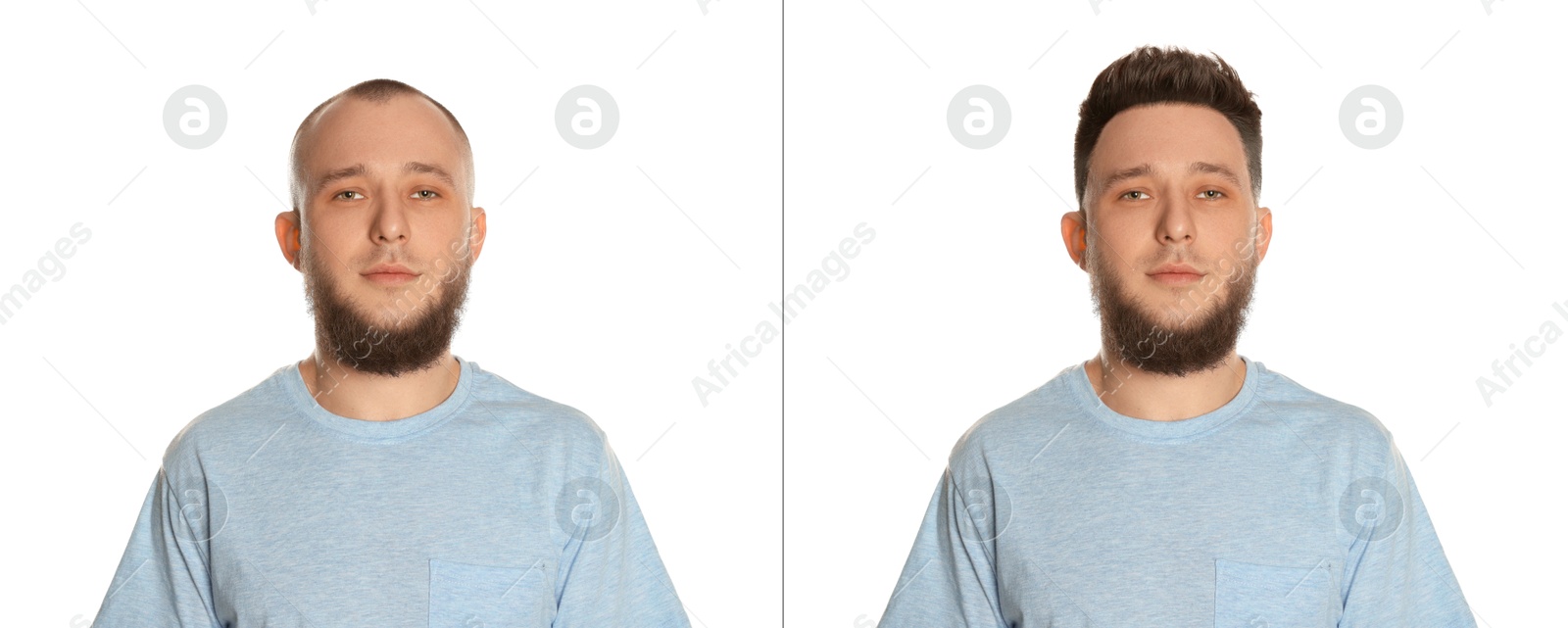Baldness. Man before and after wearing wig or hair treatment on white background Image of Baldness. Man before and after wearing wig or hair treatment on white background