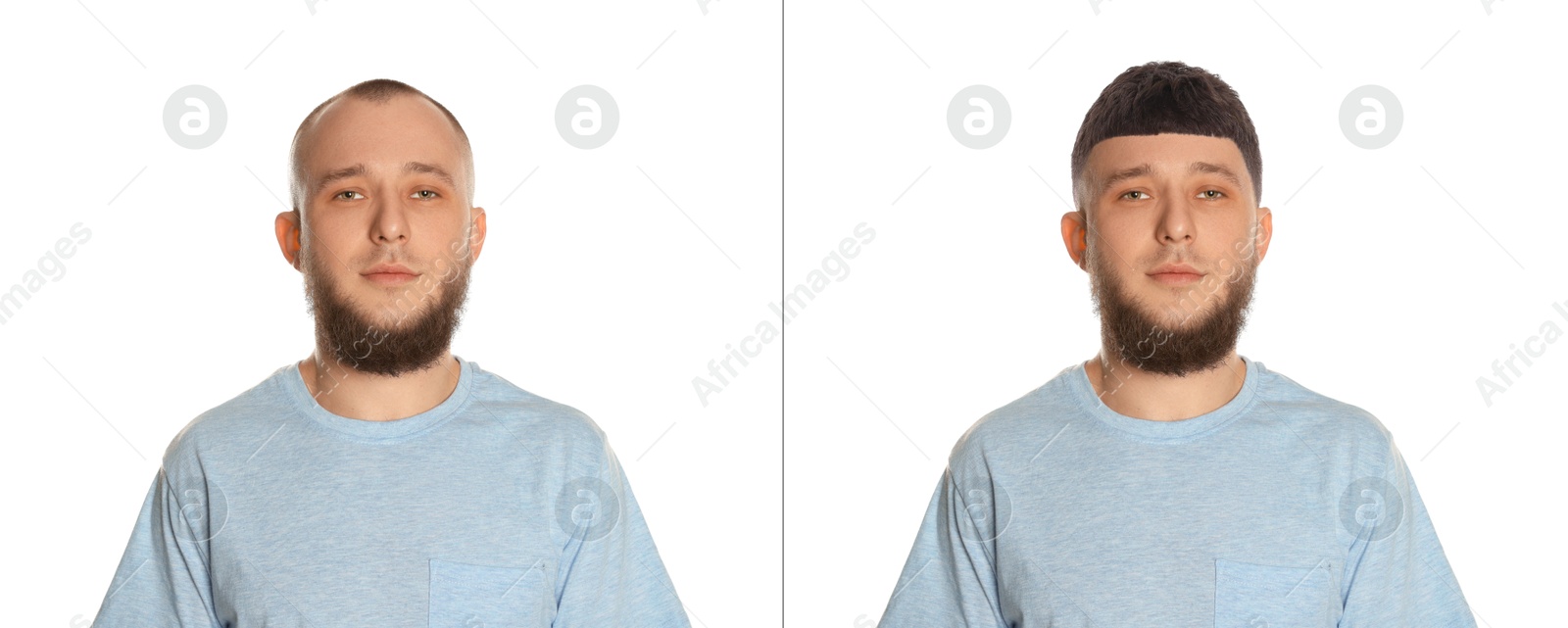 Baldness. Man before and after wearing wig or hair treatment on white background Image of Baldness. Man before and after wearing wig or hair treatment on white background