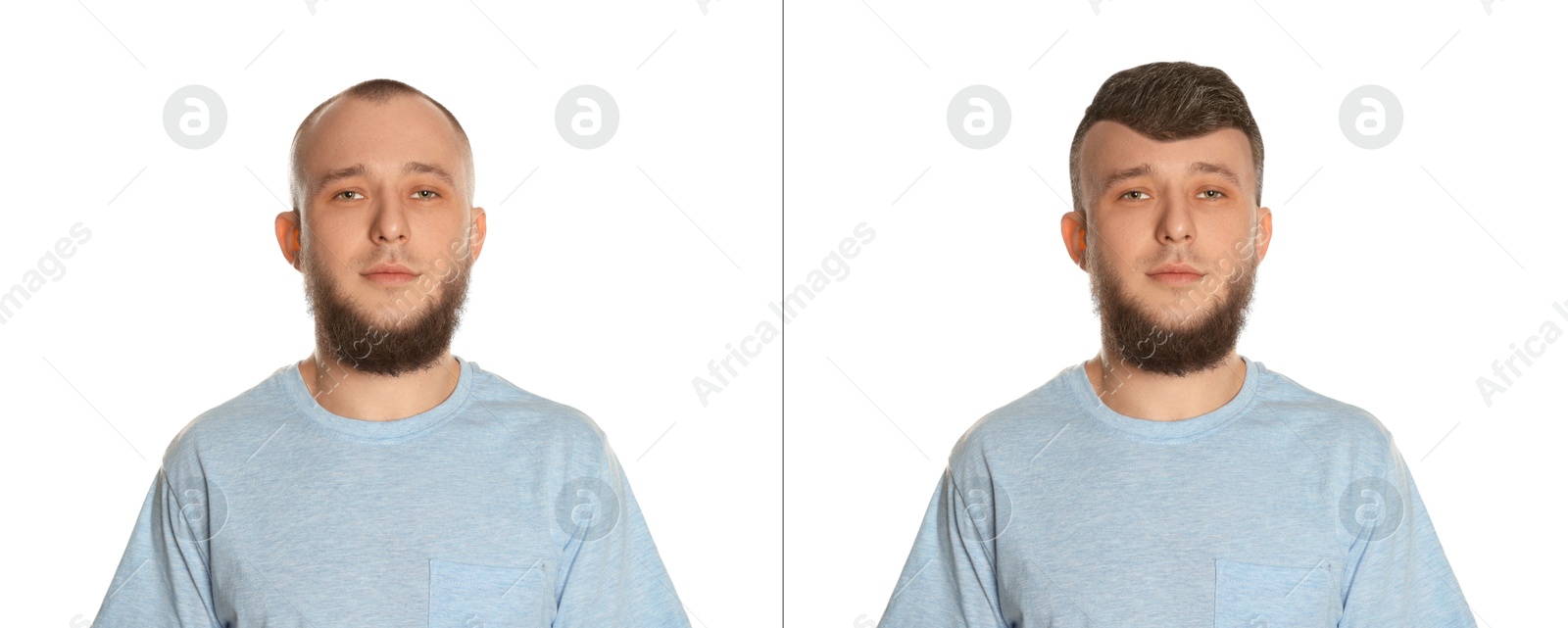 Baldness. Man before and after wearing wig or hair treatment on white background Image of Baldness. Man before and after wearing wig or hair treatment on white background