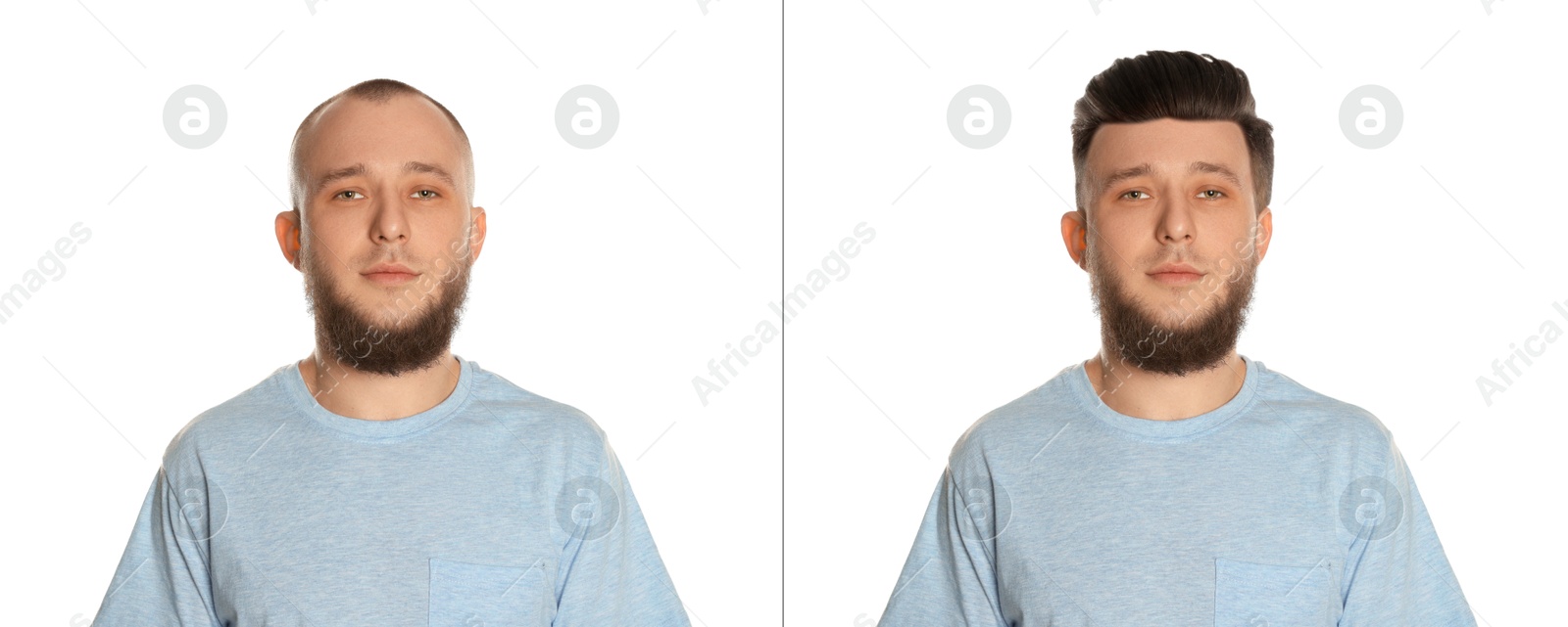 Baldness. Man before and after wearing wig or hair treatment on white background Image of Baldness. Man before and after wearing wig or hair treatment on white background