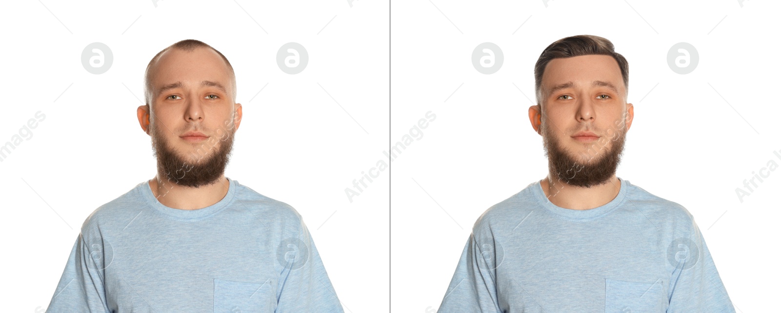 Baldness. Man before and after wearing wig or hair treatment on white background Image of Baldness. Man before and after wearing wig or hair treatment on white background