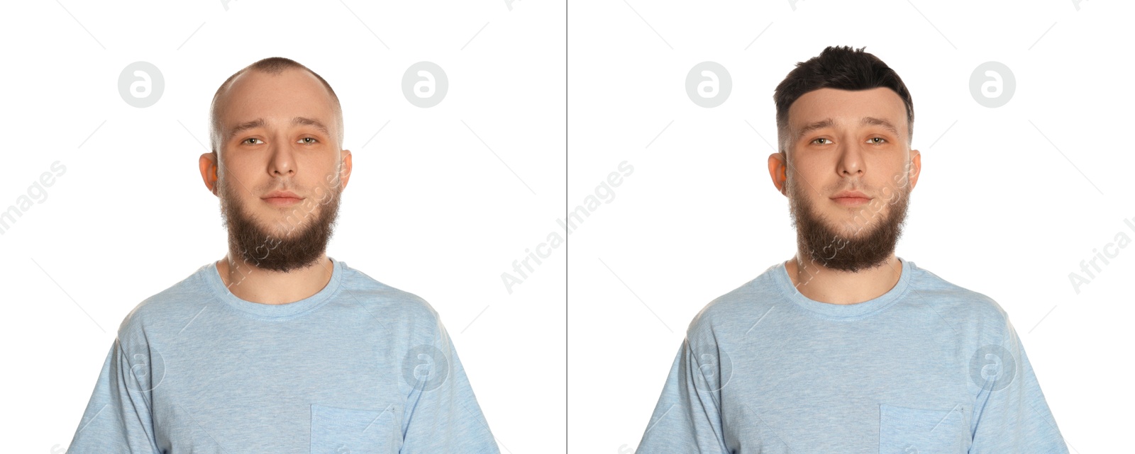 Baldness. Man before and after wearing wig or hair treatment on white background Image of Baldness. Man before and after wearing wig or hair treatment on white background