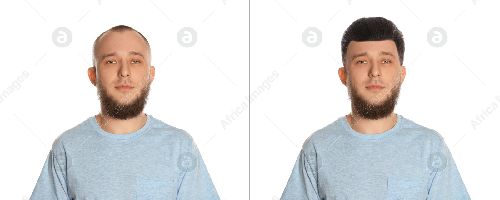 Baldness. Man before and after wearing wig or hair treatment on white background Image of Baldness. Man before and after wearing wig or hair treatment on white background