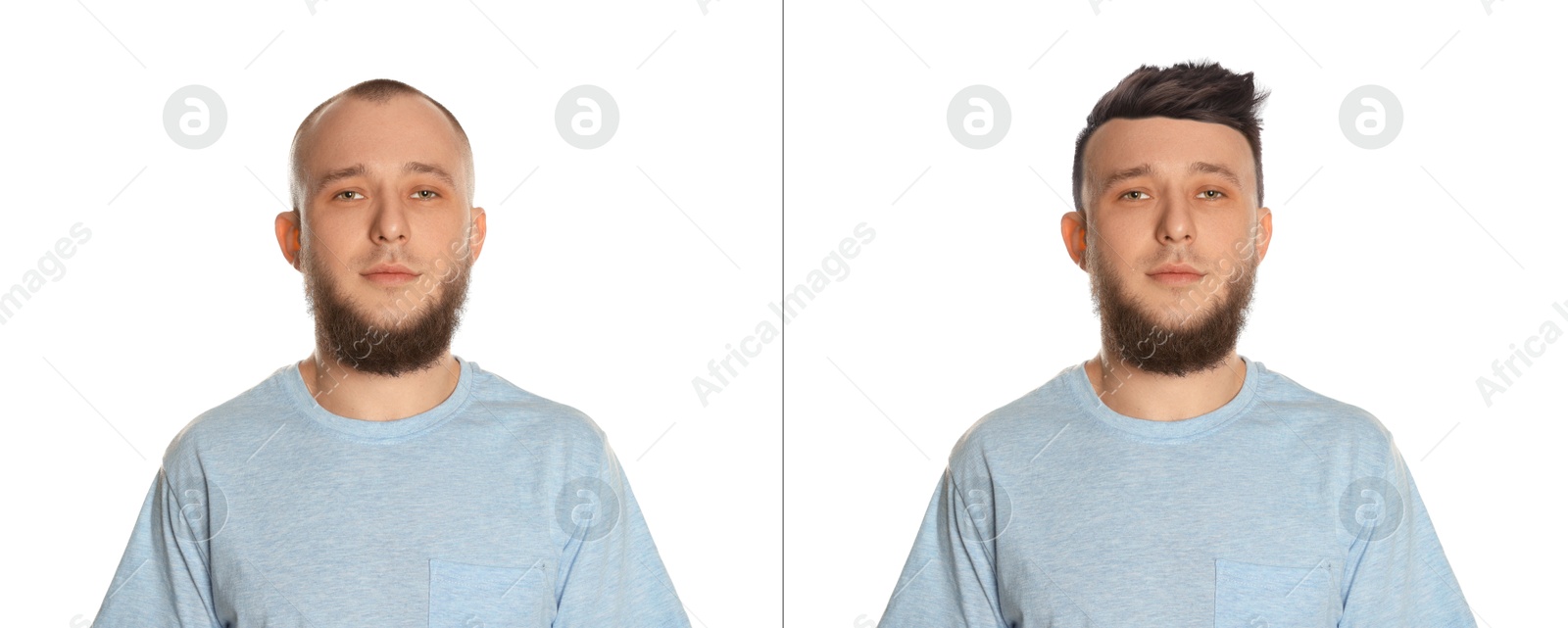Baldness. Man before and after wearing wig or hair treatment on white background Image of Baldness. Man before and after wearing wig or hair treatment on white background