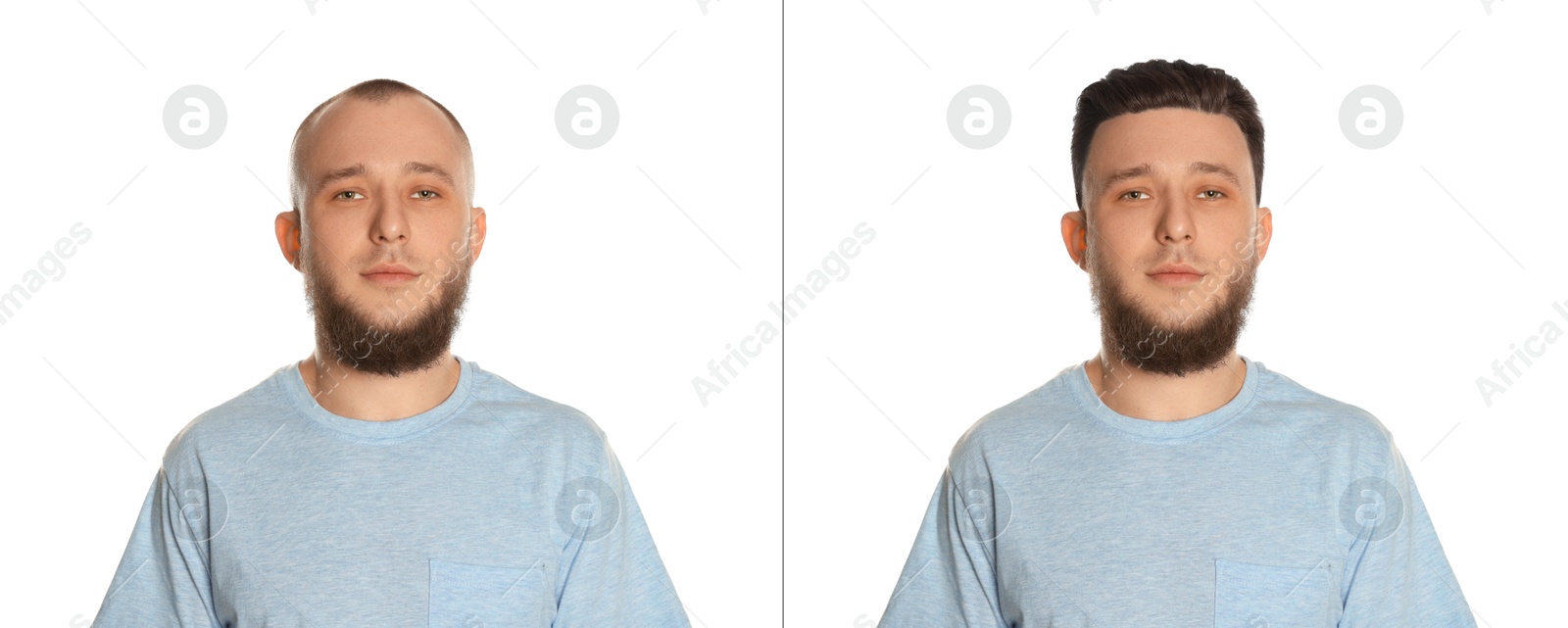 Baldness. Man before and after wearing wig or hair treatment on white background Image of Baldness. Man before and after wearing wig or hair treatment on white background
