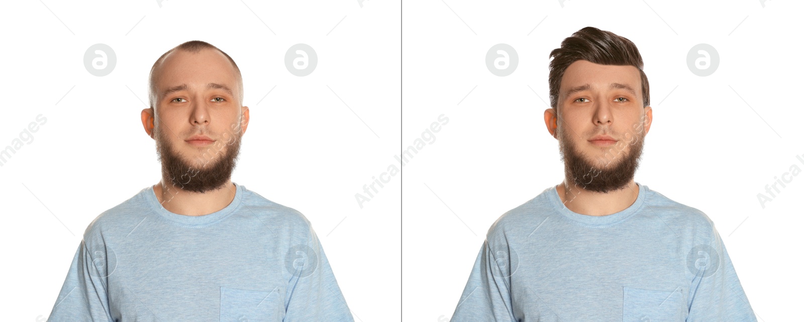 Baldness. Man before and after wearing wig or hair treatment on white background Image of Baldness. Man before and after wearing wig or hair treatment on white background