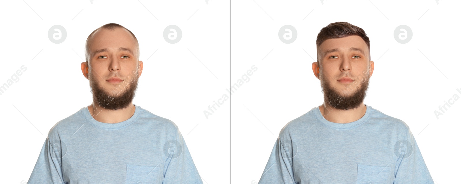Baldness. Man before and after wearing wig or hair treatment on white background Image of Baldness. Man before and after wearing wig or hair treatment on white background
